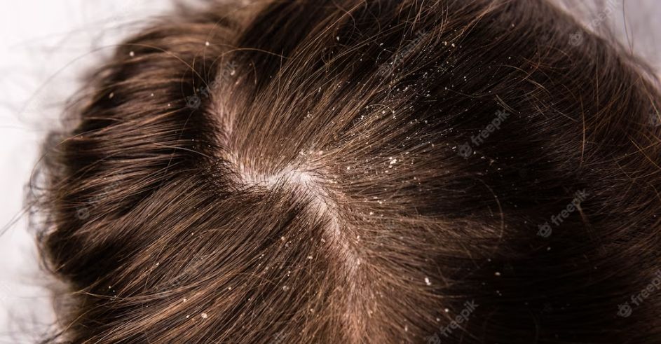 All-Natural Remedies for Dandruff