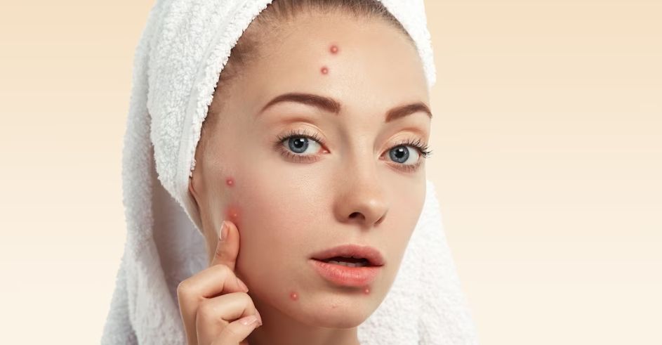 Say Goodbye to Acne and Pimples with These 5 Remedies